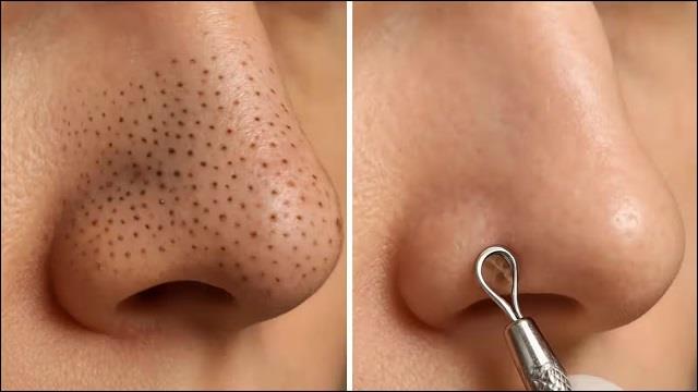 Oily Skin में बार- बार आ रहे हैं Blackheads का करें इन घरेलू उपायों से खत्मा