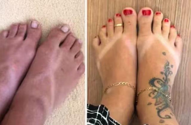 धूप से पैरों पर आ गए चप्पल के निशान तो काम आएंगे ये घरेलू उपाय