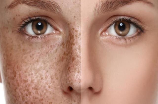 Pigmentation और  Tanning को एक समझने की बिल्कुल ना करें गलती, ये है बिल्कुल अलग