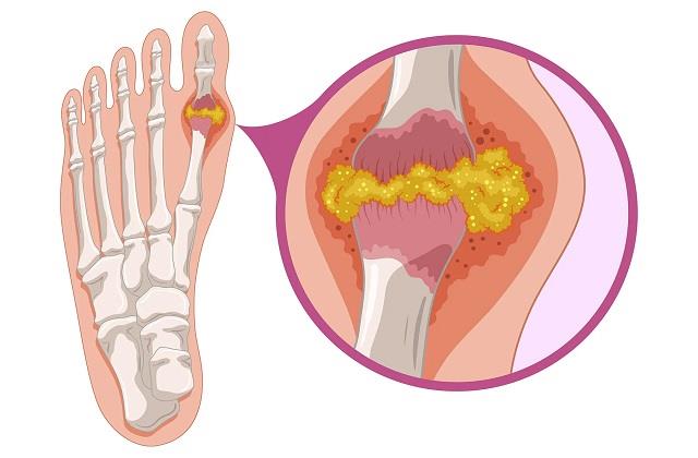 जोड़ों में दर्द का कारण Uric Acid, ये खाया तो बढ़ जाएगी समस्या