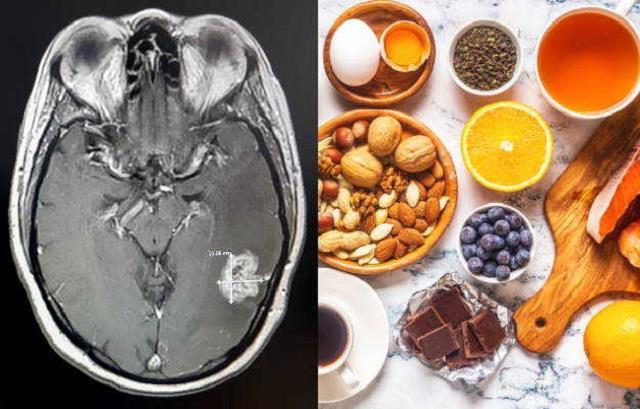 Brain Tumor का Risk बढ़ाती हैं आपकी ये खाने की आदतें, आज ही कर दें अपनी लाइफ से दूर