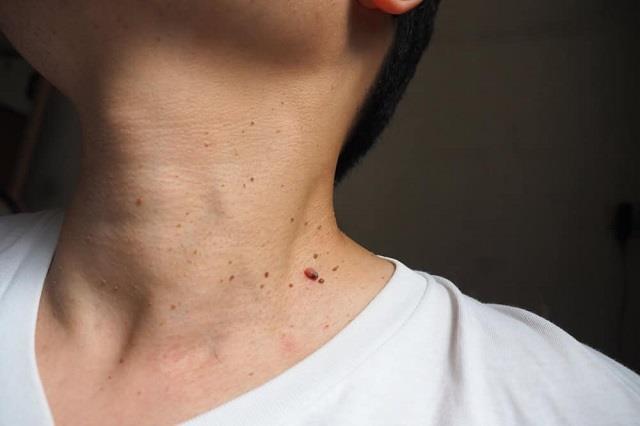 Skin पर दिखते हैं डायबिटीज के ये 2 लक्षण, डॉक्टर ने बताया कैसे पहचानें