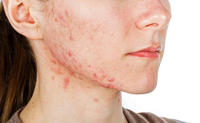 Oily Skin पर ये गलतियां पड़ सकती हैं भारी, बढ़ जाते हैं Pimples