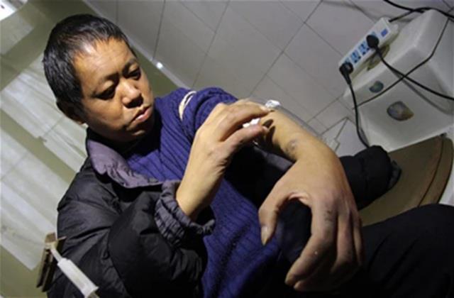 गरीब की दोनों किडनी हुई फेल, 13 सालों तक कुकर की मदद से किया घर में Dialysis