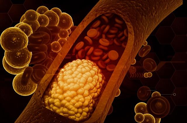आपका Cholesterol लेवल बहुत ज्यादा अगर Body दे रही ये संकेत