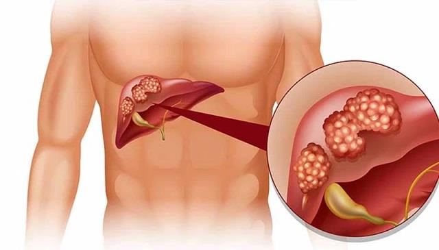 फैटी लिवर को कैसे करें रिवर्स? डॉक्टर ने बताए असरदार उपाय