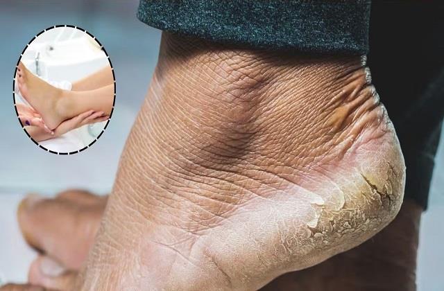 फटी एड़ियों और पैरों की बदबू से हैं परेशान, अपनाएं ये आसान देसी नुस्खा