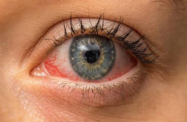 आंखों में दिखें ये संकेत तो हो सकते हैं Conjunctivitis के लक्षण!