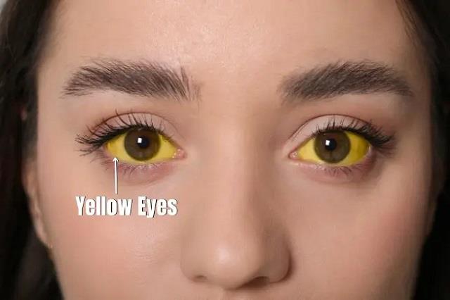 आंखों का पीलापन और Dark Urine को न करें नजरअंदाज, हो सकते हैं इस बीमारी का संकेत