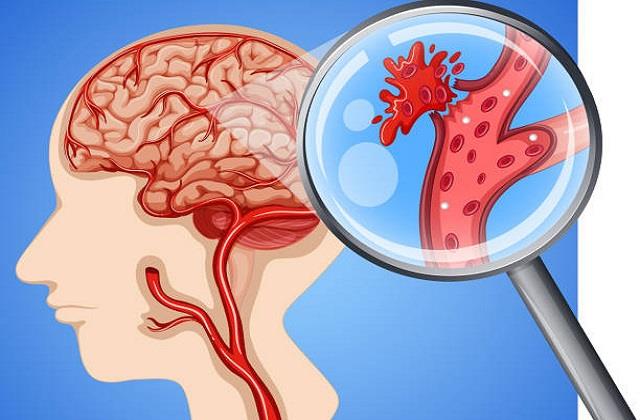 Brain Clotting मामले में भारतीय अक्सर कर देते हैं ये बड़ी गलती, यहीं होती जानलेवा