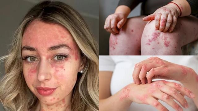 बारिश के मौसम में इन गलतियों की वजह से बढ़ सकता है  Skin Infection