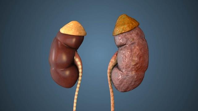 20 साल के बाद Kidney Check-up होगा जरूरी! संसदीय समिति ने की बड़ी सिफारिश