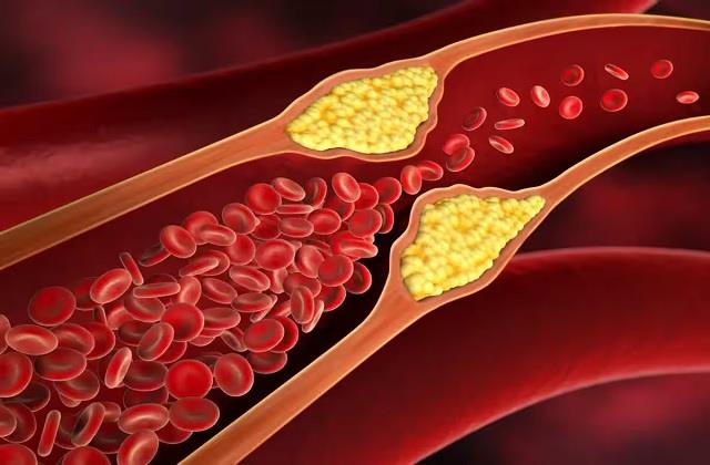 PCSK9 दवा क्या है और आम दवाओं से कैसे अलग, जानें नई कोलेस्ट्रॉल गोली कैसे करती है काम