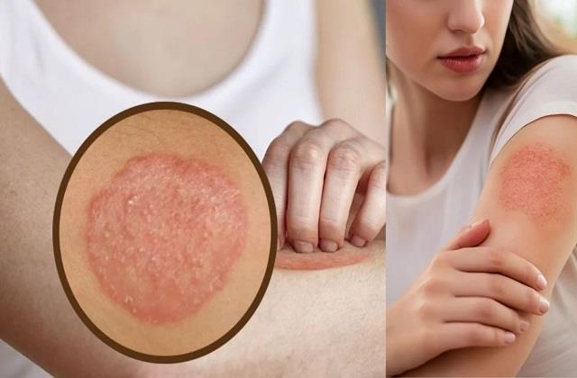 बारिश में Skin Infection से हैं परेशान? इन छोटी-छोटी गलतियों को तुरंत छोड़े