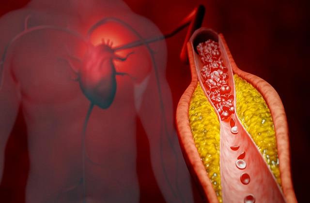 कोलेस्ट्रॉल बढ़ गया है तो डाइट में शामिल करें ये चीजें, Bad Cholesterol होगा कम