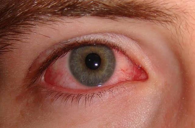आंखें लाल होना बीमारी का संकेत या नॉर्मल बात? जानिए इसका कारण और इलाज भी