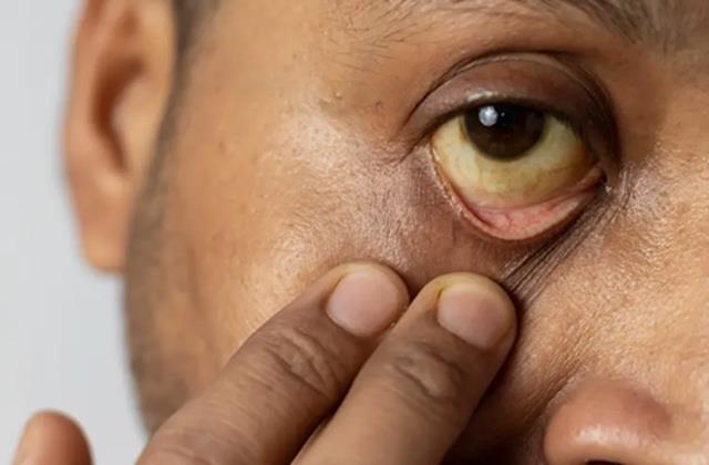 आंखों पर भी दिखता है लिवर की खराबी का असर,  Yellow Eyes है खतरे की निशानी