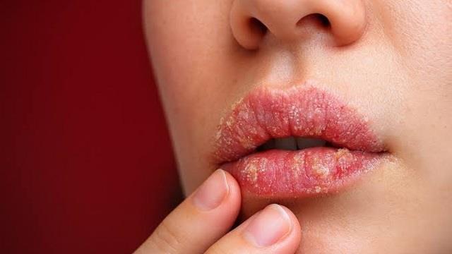 Monsoon Beauty Tips: बारिश में फट रहे हैं होंठ? इन Tips से पाएं मुलायम और गुलाबी होंठ