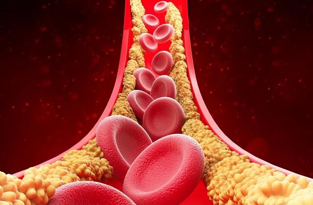Cholesterol आपको बहुत परेशान कर रहा है तो ये चीजें खा लें-इसे बंद कर दें
