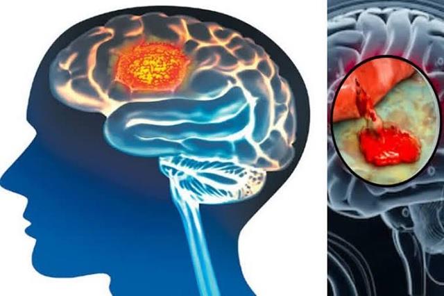 क्या नाक के रास्ते निकाला जा सकता है ब्रेन ट्यूमर? जानिए किन ट्यूमर में अपनाई जाती है यह सर्जरी