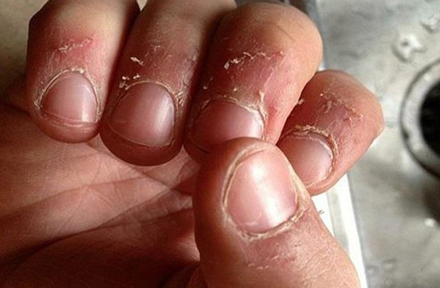 नाखूनों के पास बार-बार छिलती है खाल? जानें इसकी वजह और राहत के 5 तरीके