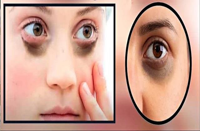 त्योहारों में देर रात तक जागने से बढ़ गए Dark Circles को दूर करने के लिए अपनाएं ये आसान टिप्स