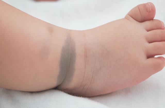 शरीर पर ऐसे ही नहीं होते Birthmark,  आम से दिखना वाला ये निशान सालों बाद करता है नुकसान