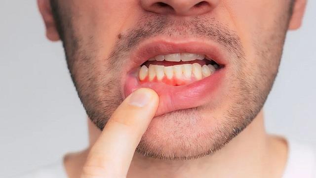 मसूड़ों की बीमारी से हो सकता है अल्जाइमर!रिसर्च में सामने आया चौंकाने वाला दावा