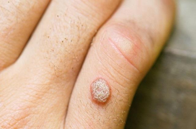 शरीर पर अचानक क्यों निकलने लगते हैं मस्से, जानिए इसका कारण