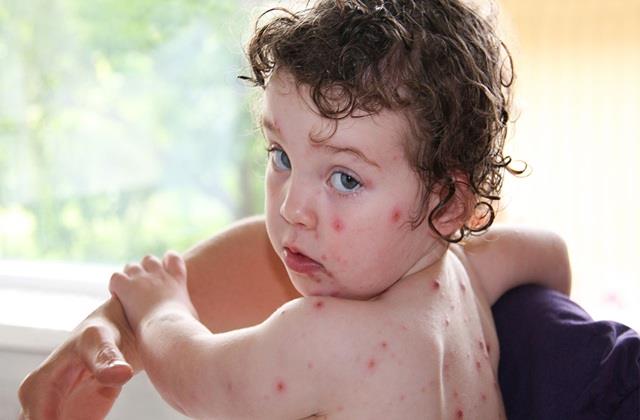 Chickenpox:  बच्चे को निकल आई है छोटी माता, तो जानिए कितने दिनों तक शरीर से जाते हैं निशान