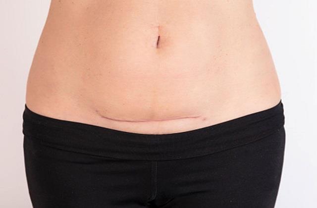 C-Section के बाद बढ़ गया वजन, जानें किन तरीकों से धीरे-धीरे करें कम