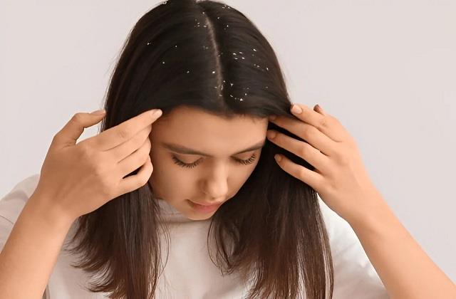 सर्दियों में बढ़ जाती है Dandruff की समस्या, जानें इसके कारण और कैसे पाएं राहत