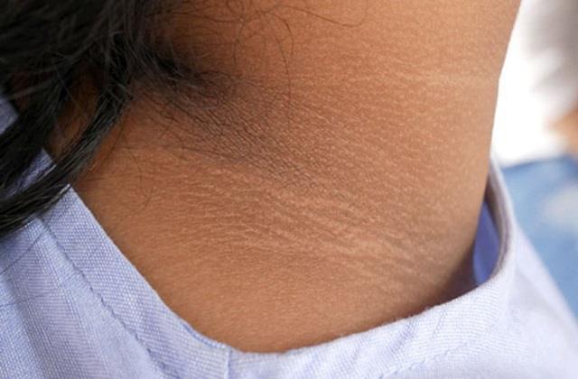 चेहरा गोरा लेकिन गर्दन काली, जानें कालापन कम करने के आसान उपाय